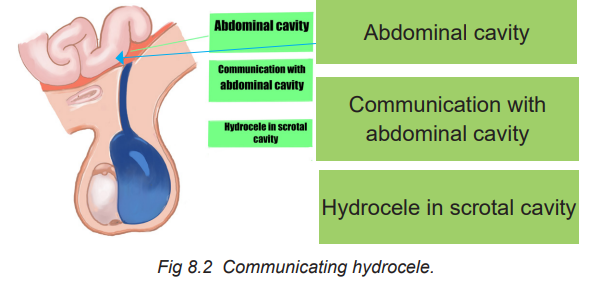 Course S6 Surgical Pathology Topic Unit8 Hydrocele And Testicular